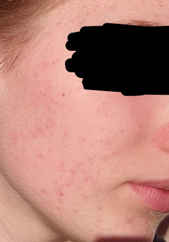 After — cheek and jaw skin documentation with eyes covered